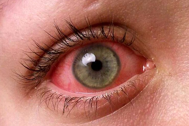 Is pink eye contagious