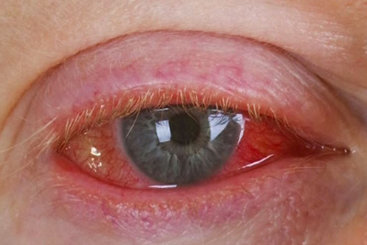 Signs and symptoms of Pink Eye