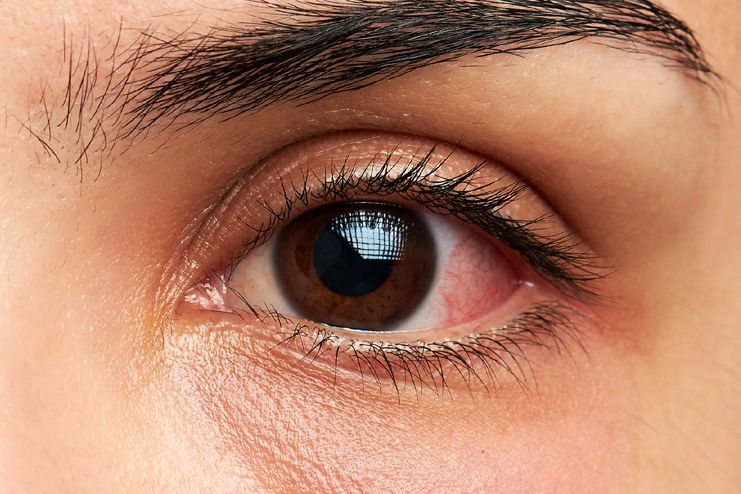 What Causes Pink Eye
