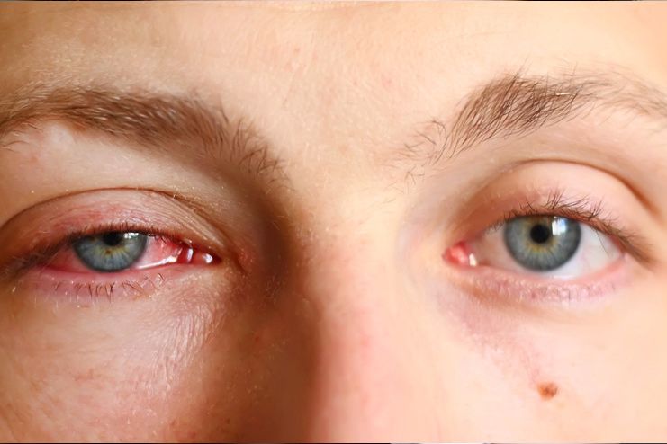 What Is Pink Eye And How Does It Look Like