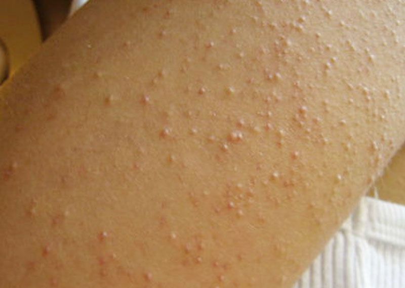 Symptoms of Gluten Intolerance How Gluten Intolerance Effects us