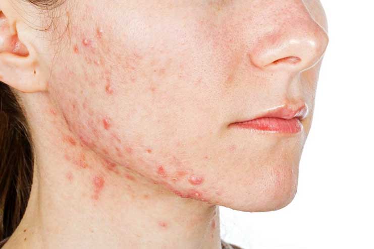 Benefits of Sunlight for Acne