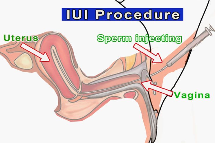 IUI or intrauterine insemination