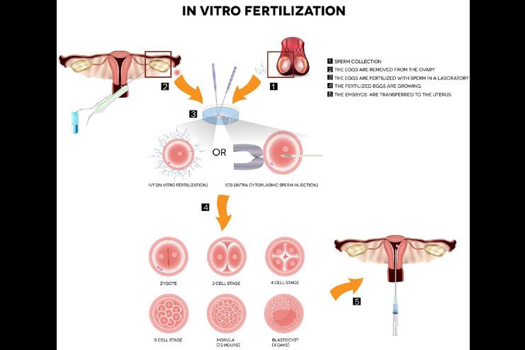 IVF or in vitro fertilization