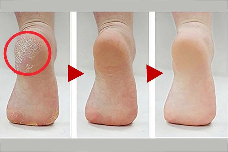 Aspirin removes calluses from feet