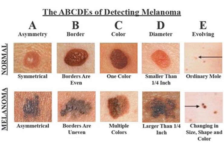 skin cancer sign and symptoms