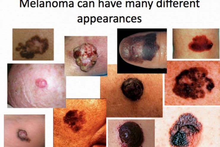melanoma skin cancer are