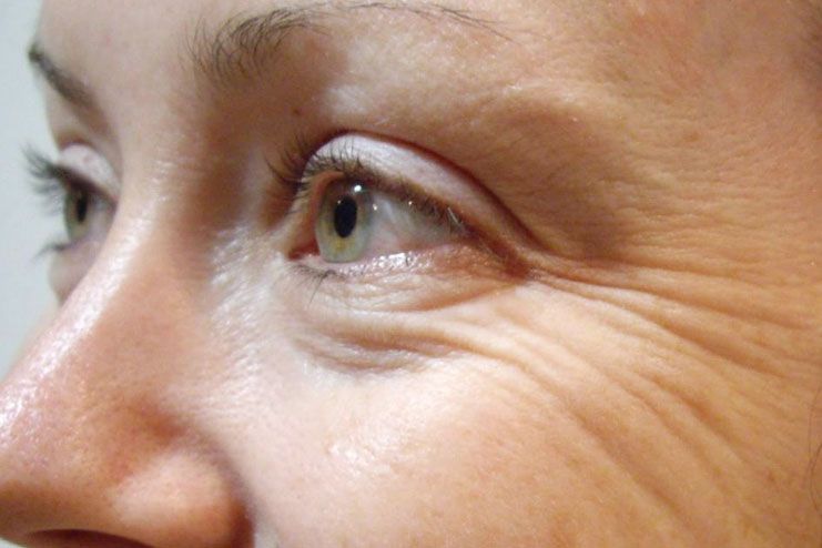 Tips and More Precautions for Wrinkles