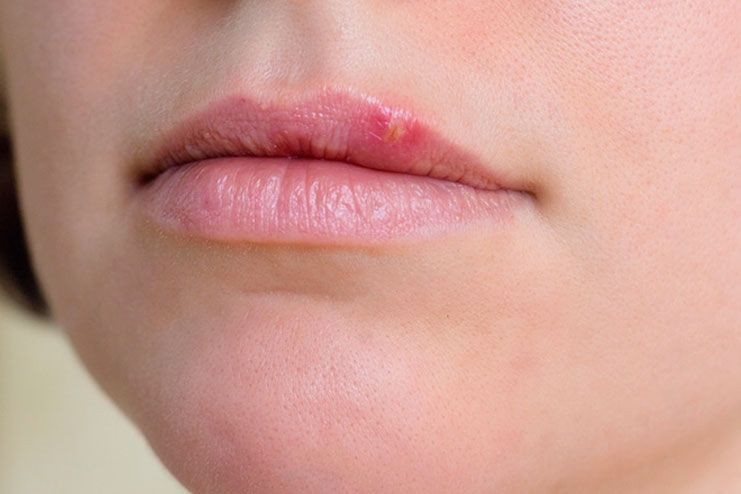 get rid of cold sores fast