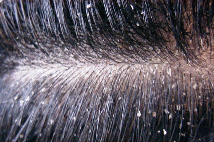 Reasons for dry scalp