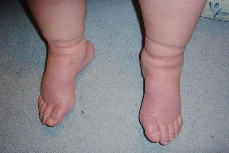 What are cankles