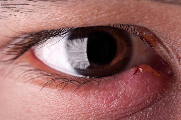 What to do about a stye