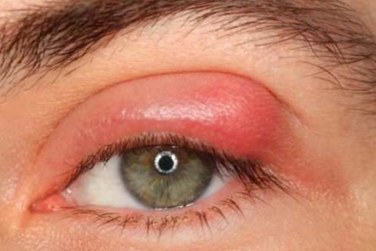 How to treat stye eye