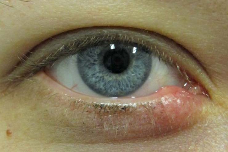 How do you prevent a stye on eye