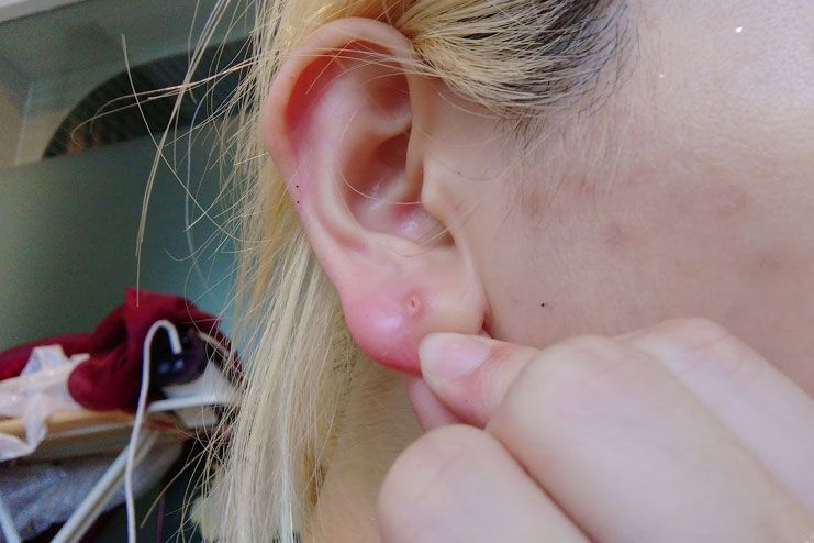 pimple in earlobe