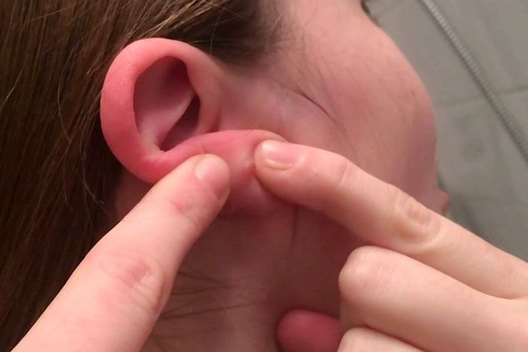 identify a pimple in earlobe