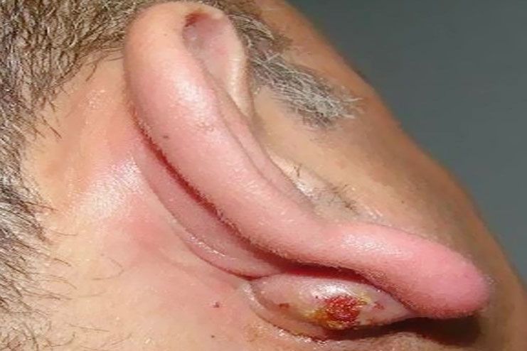 Treatment of pimple in earlobe