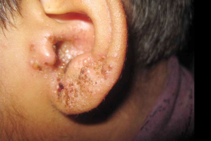 Prevention of pimple in earlobe