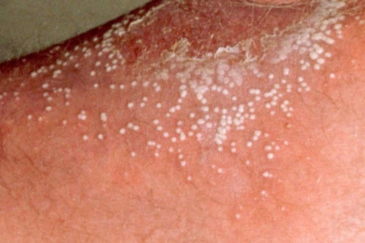 common causes for small itchy bumps