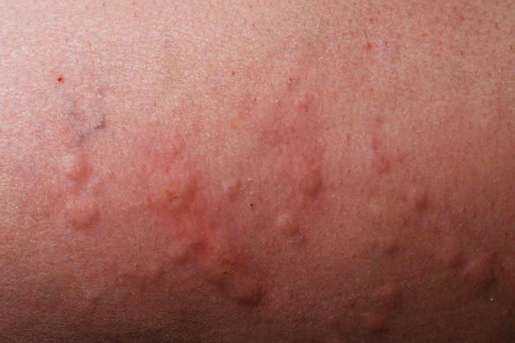 How To Cure Small Itchy Bumps On Skin