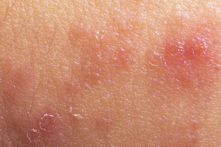 causes of armpit rash