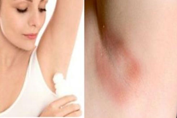 get rid of armpit rash fast