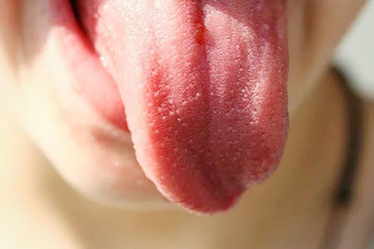 symptoms of lie bumps on tongue
