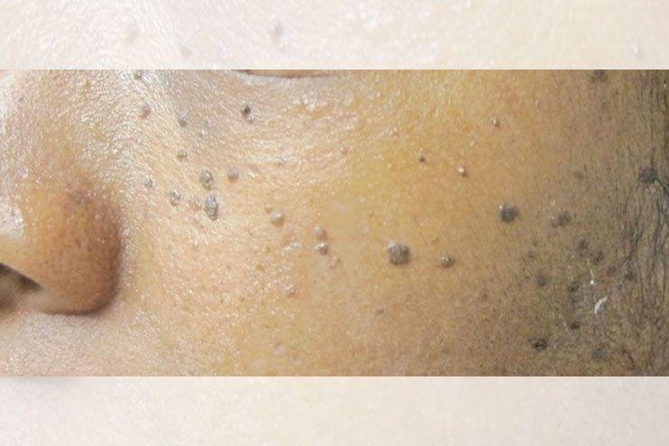 causes black spots on skin