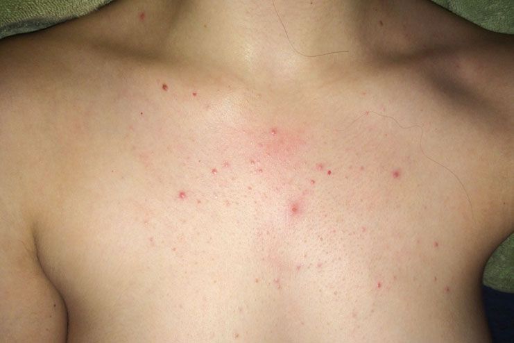 prevent acne on chest