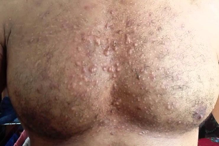 prevent chest acne