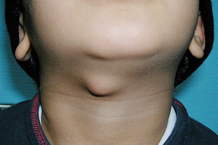 Common causes of chin lump