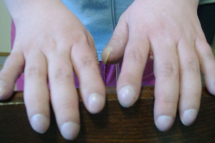symptoms of clubbed fingers