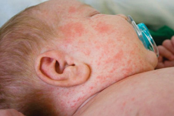 German measles or Rubella