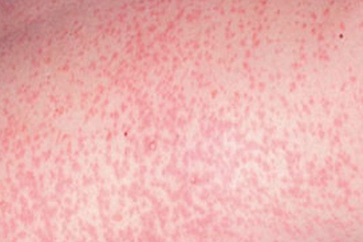 General Symptoms of German Measles