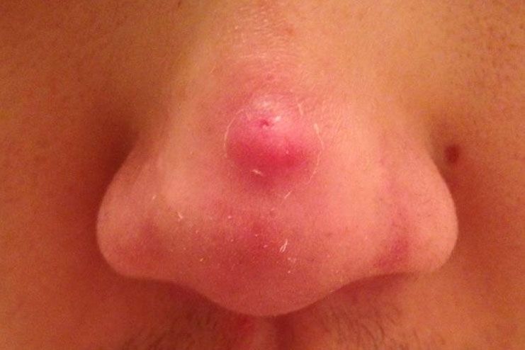 cause of pimple no nose