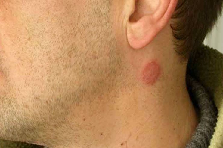 symptoms of rash on neck