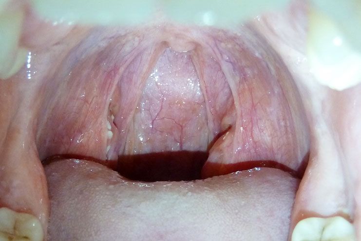 causes of tonsillitis
