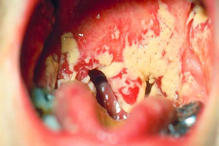 What are tonsil stones