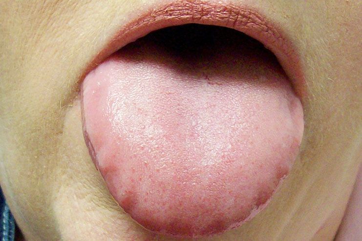 the symptoms of wavy tongue
