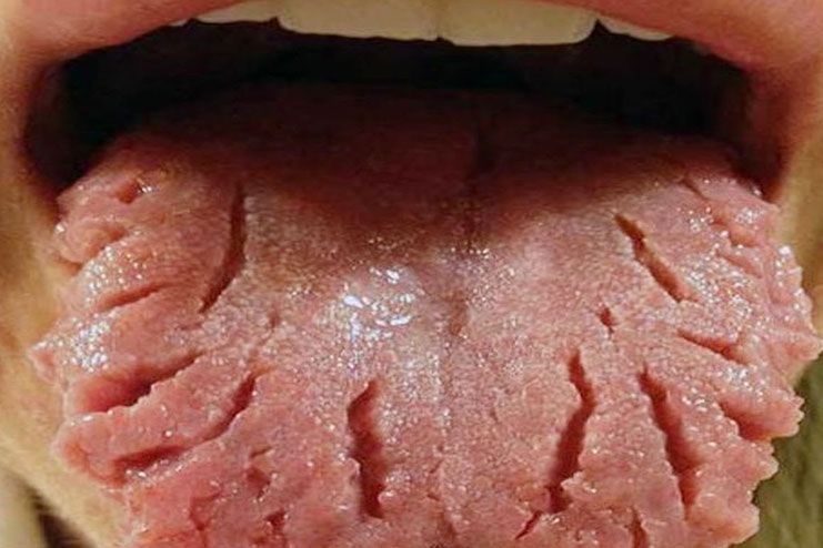 causes of wavy tongue
