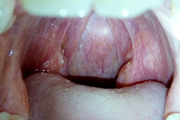 Green Spots On Throat 75
