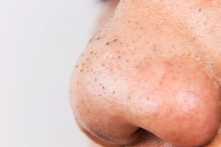 What are Blackheads