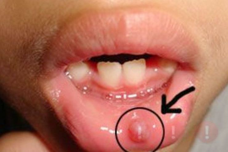 common causes of bumps on lips