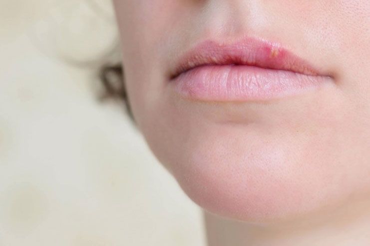 precautions for bumps on lips