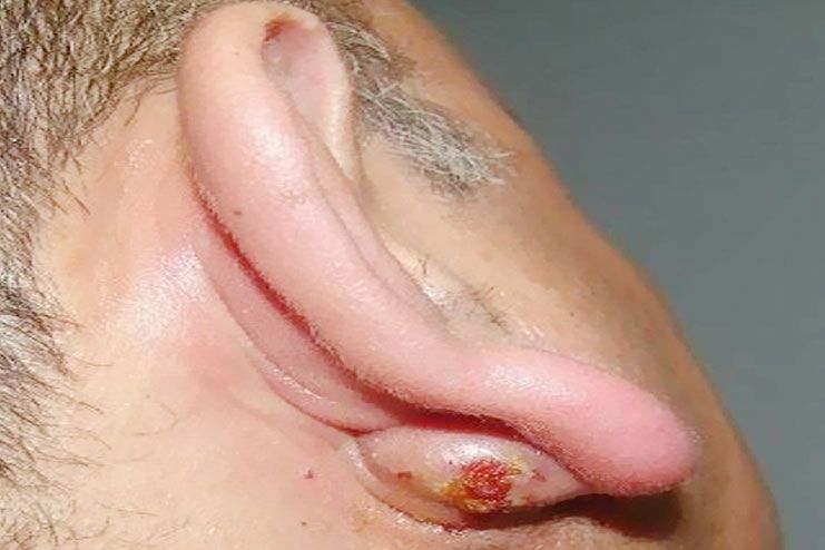 signs and symptoms of lump behind ear