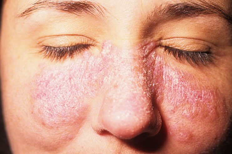 lupus skin rash