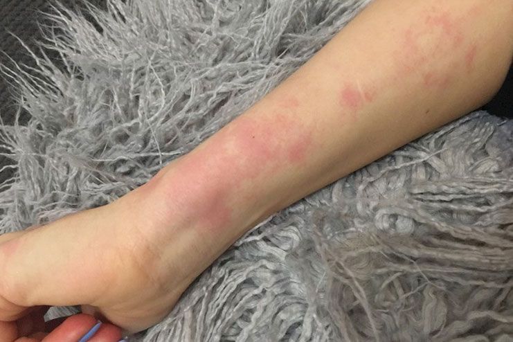 lupus skin rash