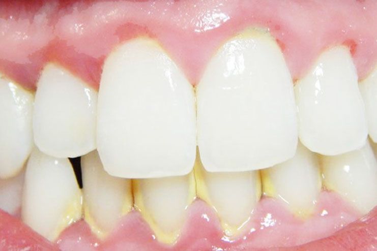 what are the home remedies to get rid of tartar on teeth'