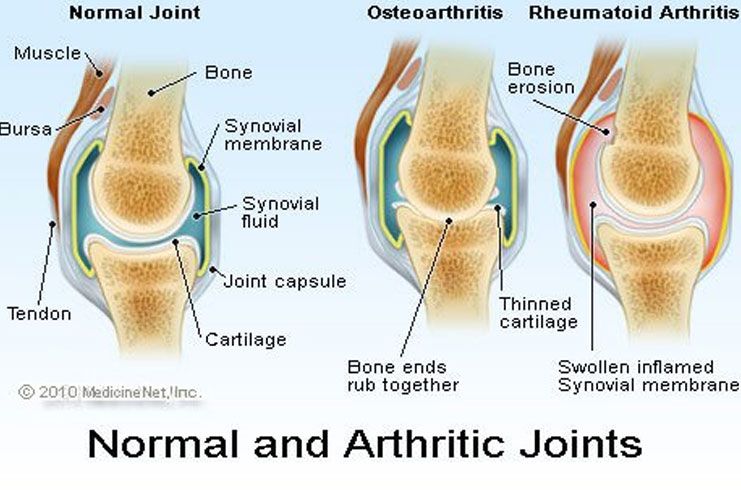 Symptoms Of Rheumatoid Arthritis