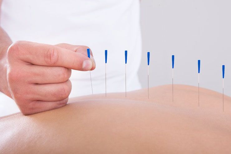 Acupuncture for rheumatoid arthritis